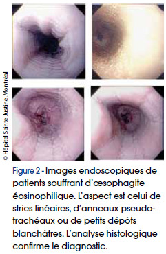 OESOPHAGE-ET-SES-MAUX-FIG2