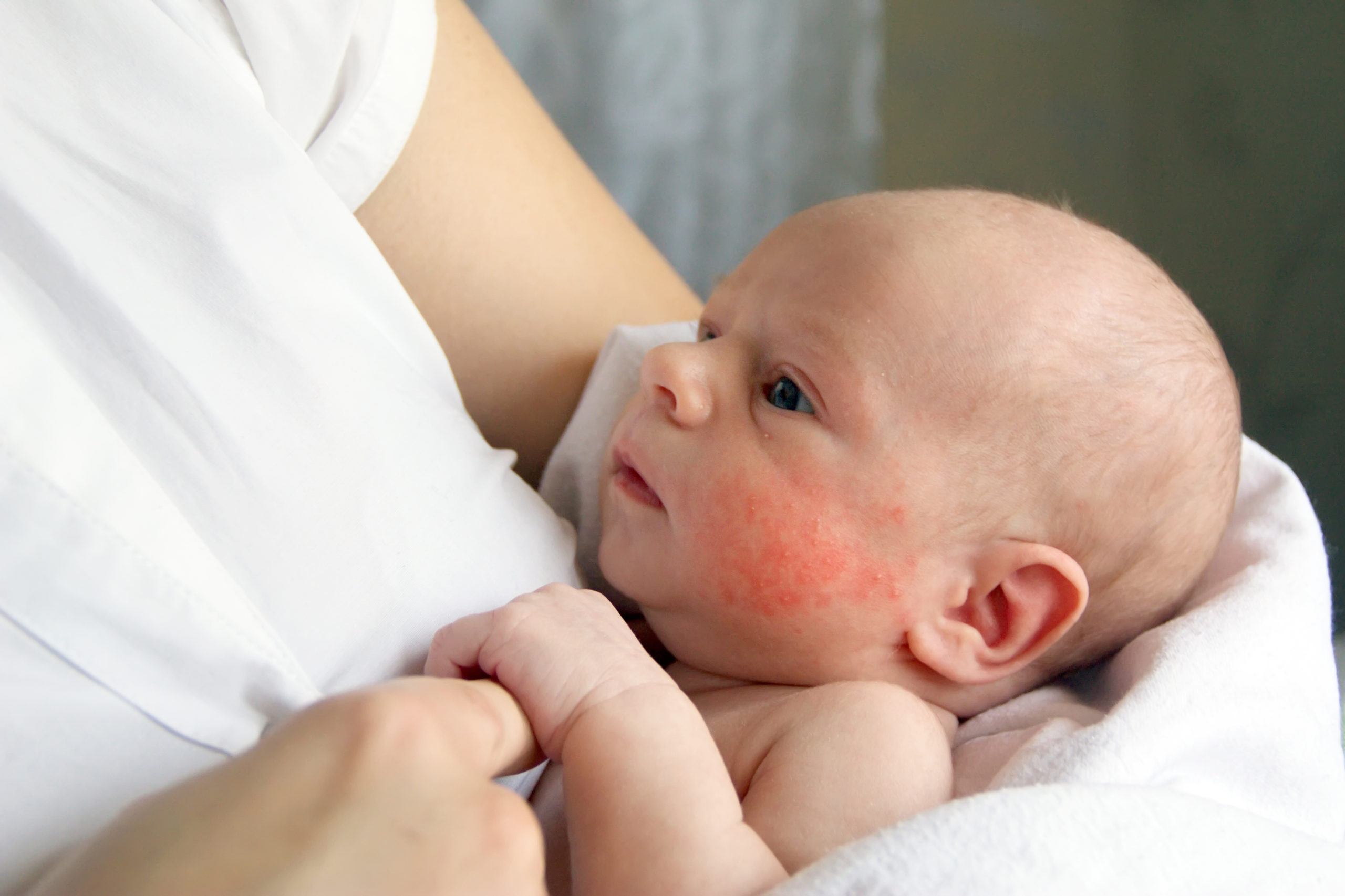 Eczéma du nourrisson : apprendre aux parents à le prévenir