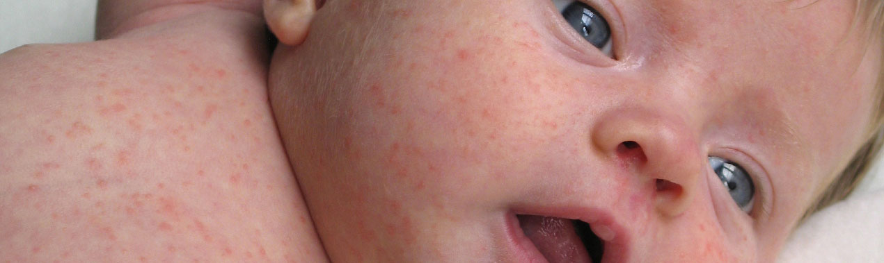 Les allergies alimentaires de l’enfant